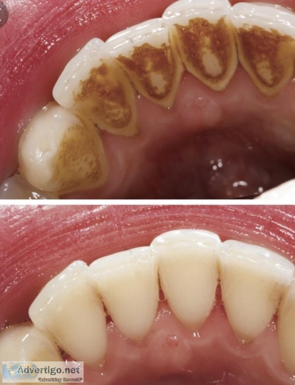 Dental cleaning