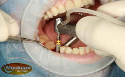 Are Dental Implants better than natural teeth