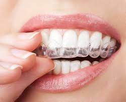 Teeth whitening houston, tx