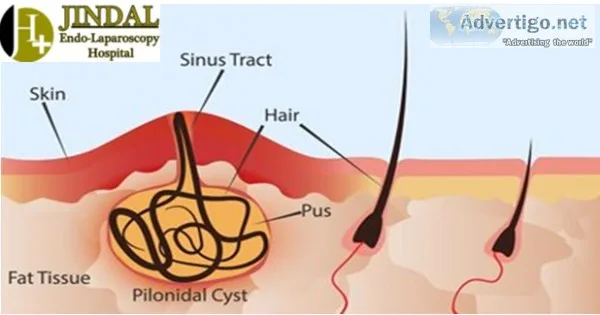 Best laparoscopy surgery hospital - jindal laparoscopy