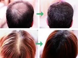 Hair Loss Medication - Revive Hair and Skin Clinic
