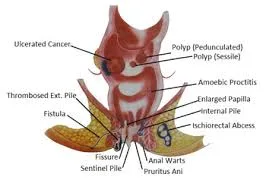 Painless laser treatment for piles in bhandup, vikhroli & mulund