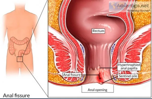 Best doctor for fissure in bhandup, vikhroli & mulund