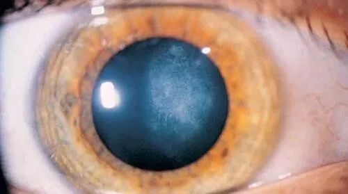 BEST CATARACT SURGERY EYE HOSPITAL IN CHENNAI