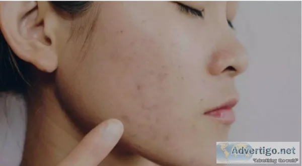 Result-oriented Acne Scar Treatment in chennai at Tamira Medical