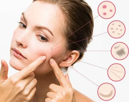 Acne Marks Treatment