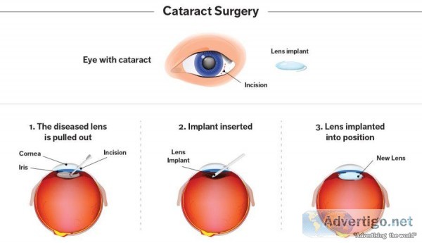 Glaucoma Specialist in Mumbai
