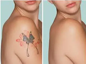 Laser tattoo removal in mumbai