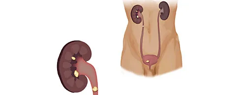 Tatkshana ayurveda - kidney disease management bangalore
