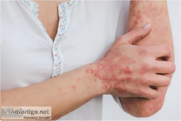 Psoriasis ayurvedic treatment | ayurvidha