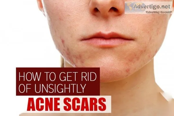 How to remove acne scars fast | ayurvidha