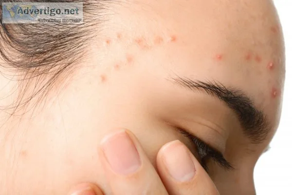 Best ayurvedic cream for acne | ayurvidha