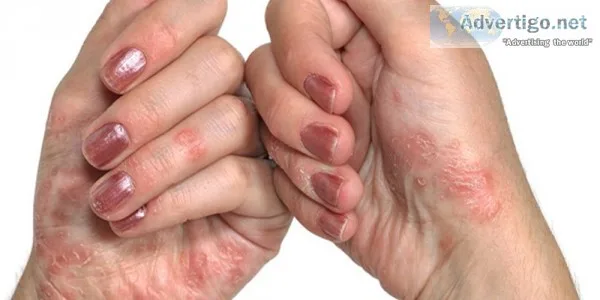 Ayurvedic cream for psoriasis | ayurvidha