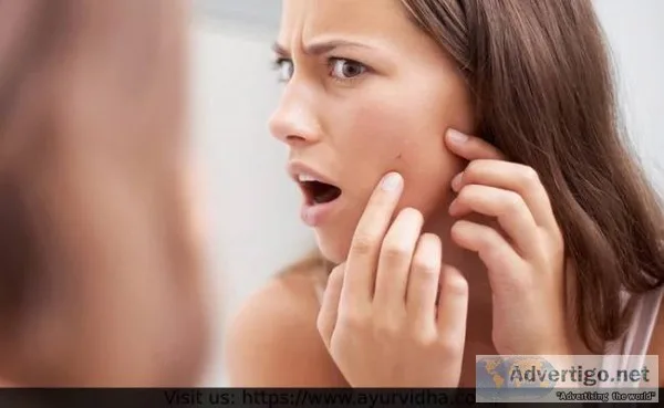 Best ayurvedic cream for pimple | ayurvidha