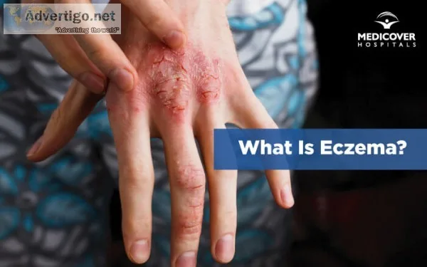 Ayurvedic medicine for eczema | ayurvidha