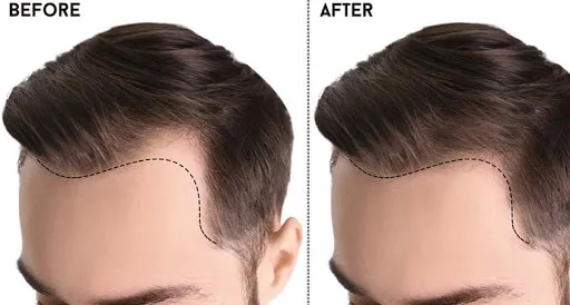 Get the best hair patch in gurgaon at affordable price