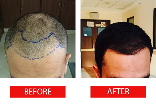 Get the best hair transplant in chennai at ahs
