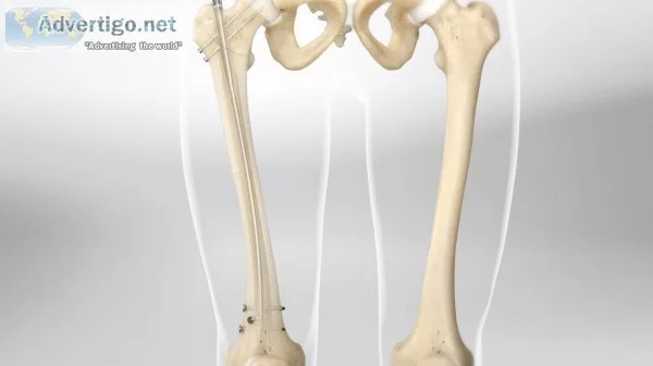 We have the best joint replacement surgeon in jaipur