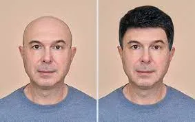Looking for a best hair fall treatment in mumbai