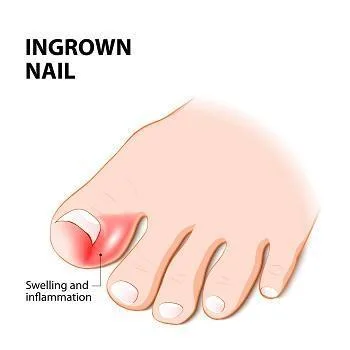 Ingrown Toenail Remedies And Causes