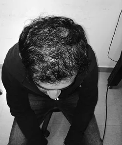 Experience the best hair transplant with ahs india