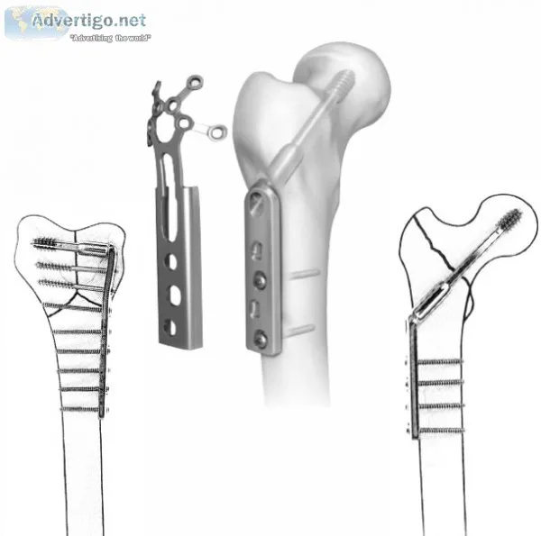 Supplier for orthopedic implants