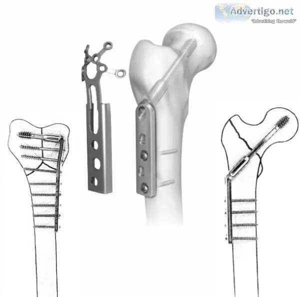 Orthopedic products manufacturers in india