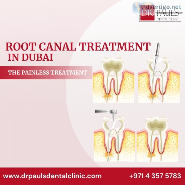 Root canal treatment in dubai