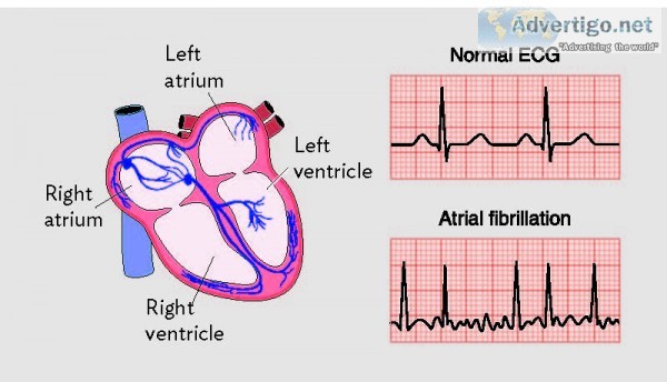 What is atrial fibrillation?