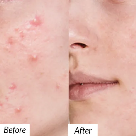 Scar removal treatment
