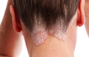 Best doctor for psoriasis treatment in delhi
