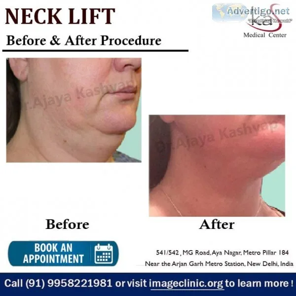 Low Cost Neck Lift Cosmetic Surgery Clinic in Delhi
