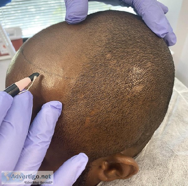 Scalp Micropigmentation Artist looking for Models