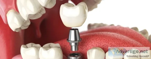 Dental implant in coimbatore