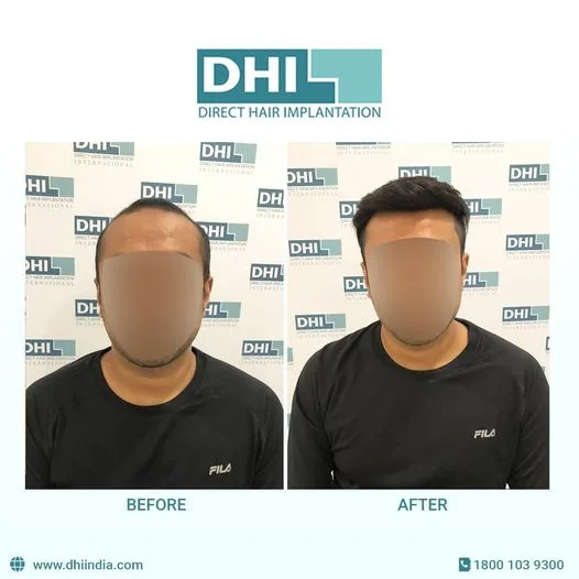 Hair transplant cost in bangalore - dhi india