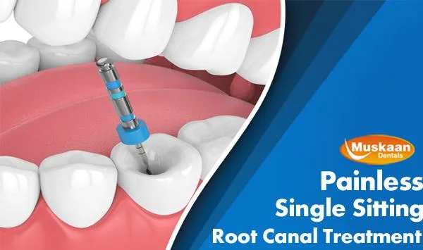 Single Sitting Root Canal Treatment