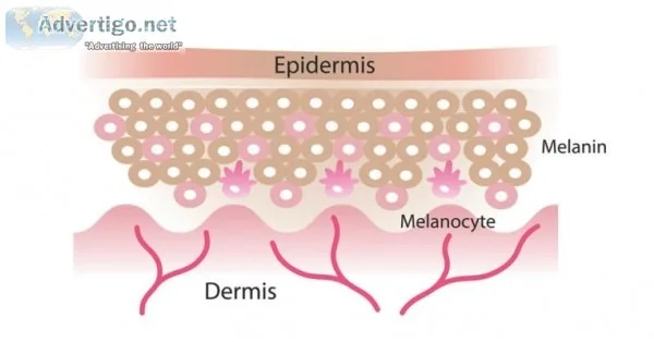 Birthmark treatment in delhi