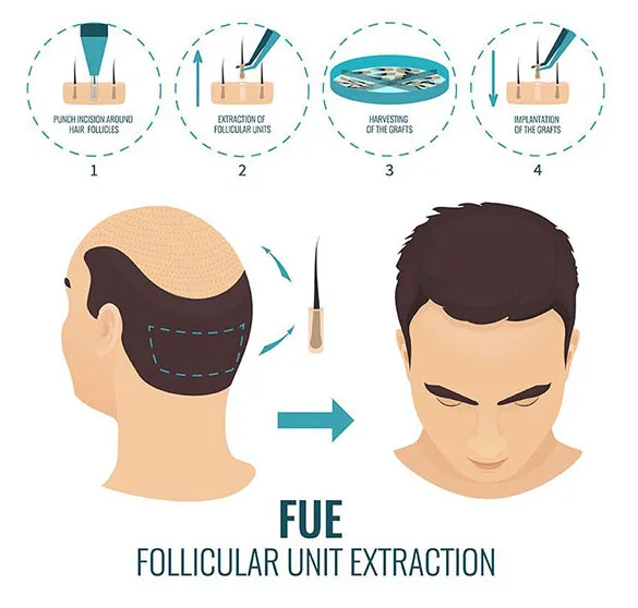 Hair transplant surgery in delhi | recon