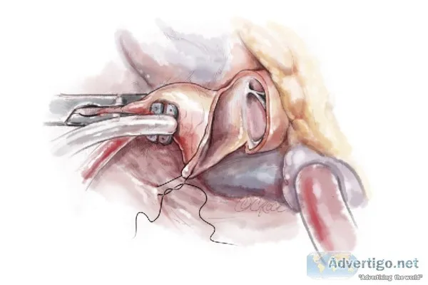 Hocm surgery in india