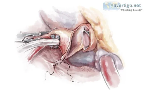Septal myectomy in delhi
