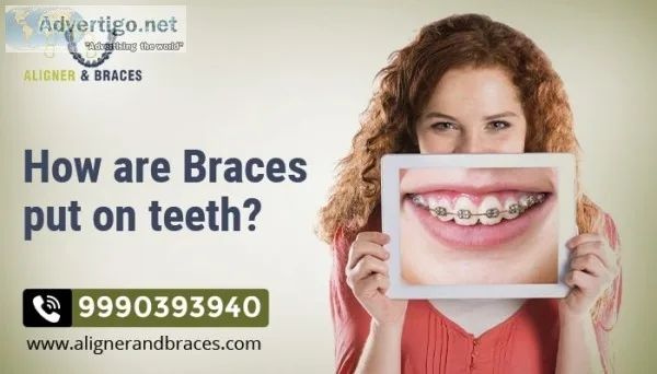 Know about how braces are put on teeth