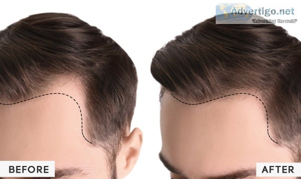 Hair loss treatment in noida