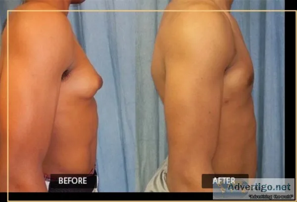 Gynecomastia surgery cost in delhi