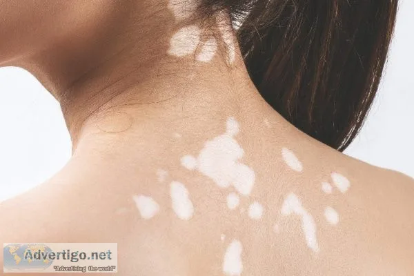 Get treatment for vitiligo from the best skin specialist in indi