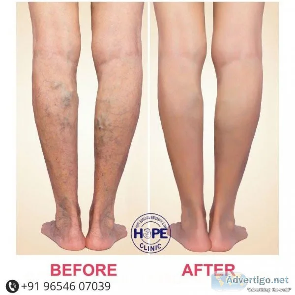 Laser Varicose Veins