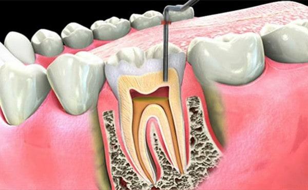 Root Canal specialist in Noida