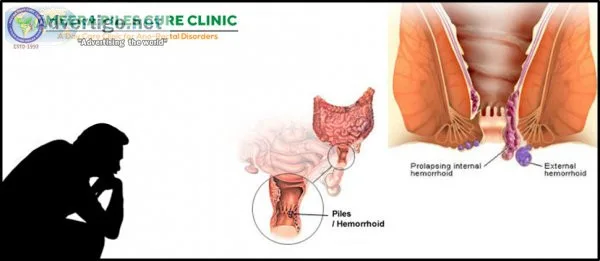 Best piles clinic in hyderabad