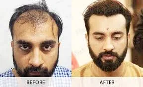 Hair transplant in india | best hair transplant india