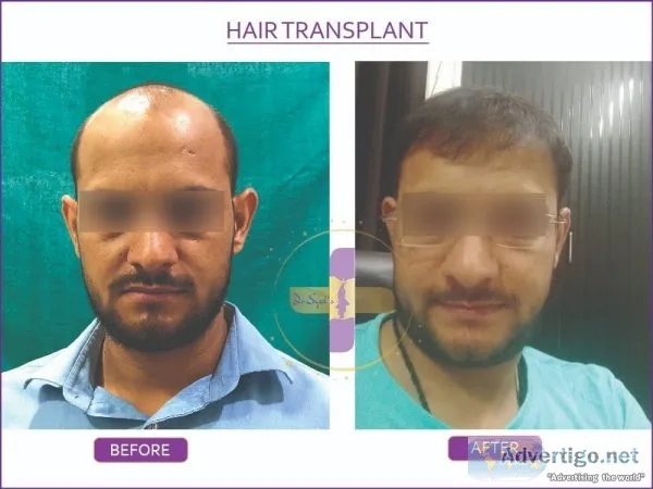 Hair transplant cost in delhi | hair transplant in delhi- dr sye
