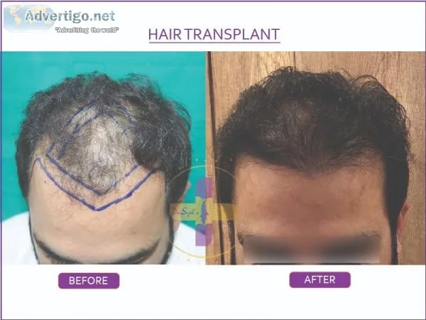 Hair transplant cost in delhi | hair transplant in delhi- dr sye